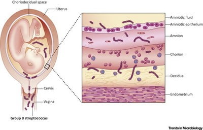 Pathogenesis and risk factors