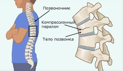 Дитячі переломи – рекомендації з обстеження, профілактики повторних