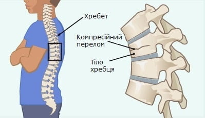 Дитячі переломи – рекомендації з обстеження, профілактики повторних