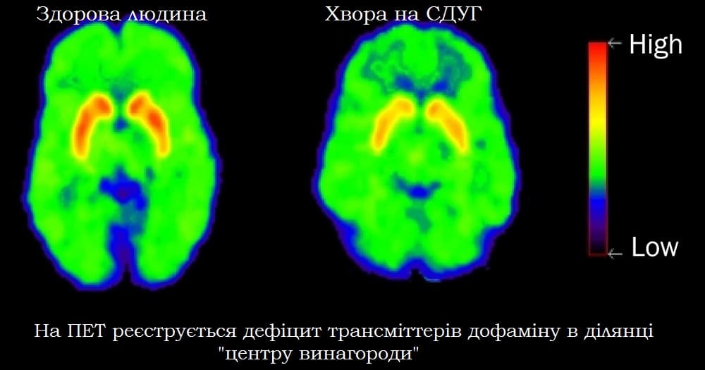 СДУГ – медичні факти про синдром дефіциту уваги й гіперактивності та його причини